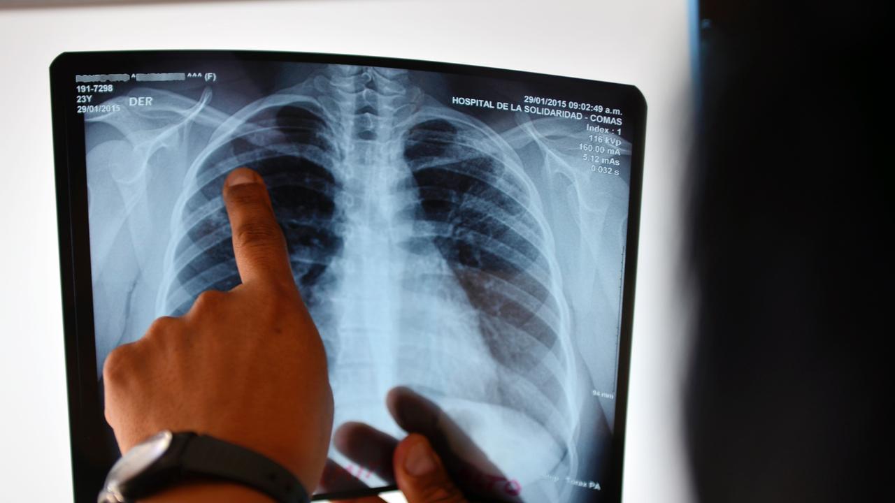 Queensland student diagnosed with tuberculosis | The Australian