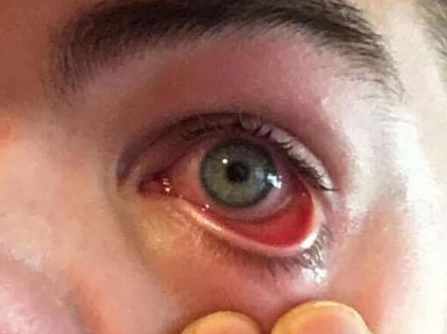 A previous case of meningococcal conjunctivitis was recorded on the Central Coast in June.