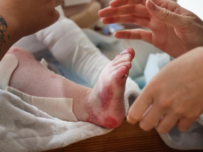 Every morning, nurses clean and dress the wounds on Jacob’s legs. Picture: David Caird