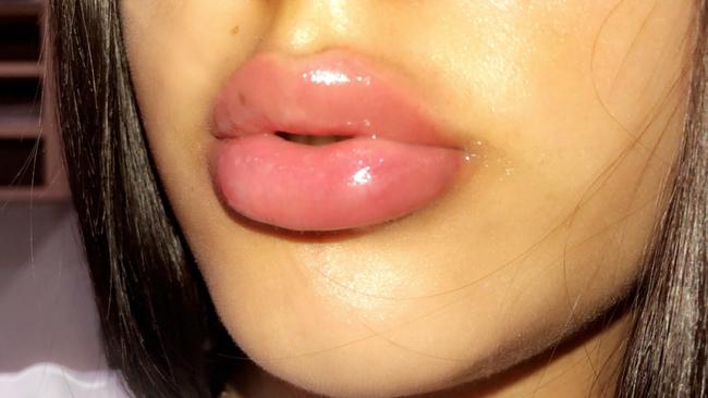 Lipfillers is one of the most popular procedures for schoolgirls hoping to impress their friends at their school formal. Picture: Supplied