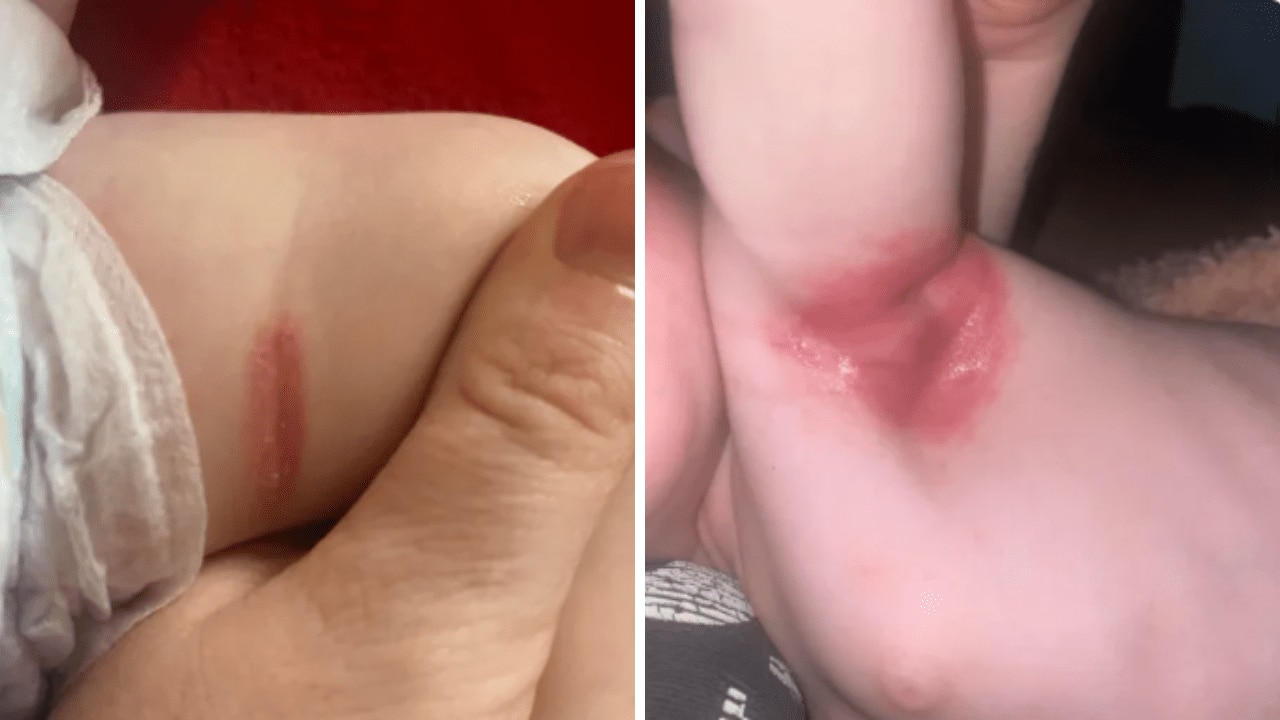 Armpit redness from rubbing deals after picking up baby