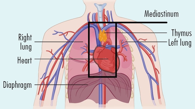 Grey zone lymphoma starts in the middle of the chest, an area known as the mediastinum, where it's thought specialised immune cells (B-cells) in the thymus turn cancerous. Picture: Lymphoma Australia