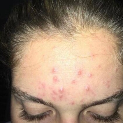 She never had issues with her skin until she turned 19, when she was put on antibiotics. Picture: Instagram/Harmonyabell