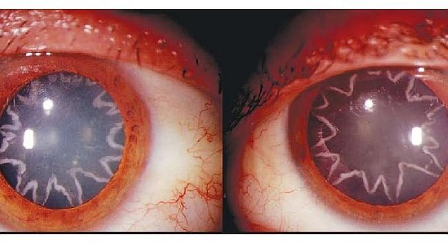 Eye wonder. An electrician develops strange star-shaped cataracts after suffering electric shock. Source: The New England Jou...