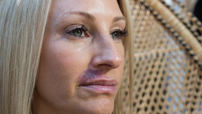 Sydney woman Kristine McCarthy, who was left with huge swelling and bruising to her lips after she had lip fillers. (Pic: Julian Andrews/AAP)