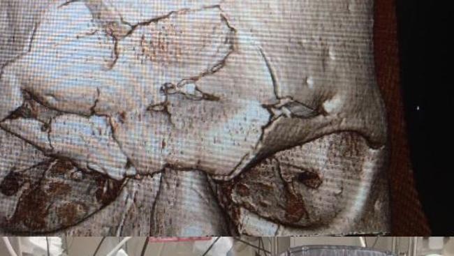 Images of Evangelista Santos’s dented skull.
