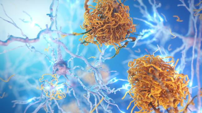 The build-up of amyloid plaques is responsible for Alzheimer's disease. Picture: Supplied
