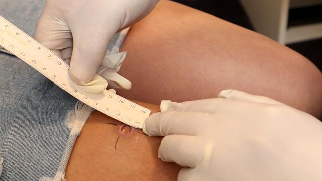 A Buruli ulcer on the leg of Shania Gana, who contracted the flesh-eating bug on the Mornington Peninsula. Picture: David Geraghty