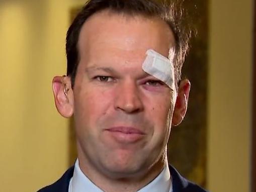 Sentor Matt Canavan bandaged. Picture Today.JPG