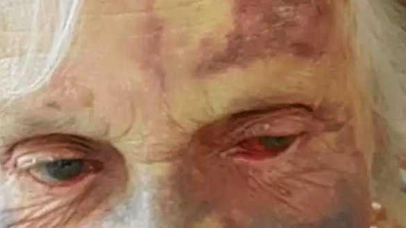 THE CIRCUMSTANCES surrounding an elderly woman's facial injuries sustained during her time at a Coffs Harbour nursing home is under investigation by federal authorities. Picture: Contributed