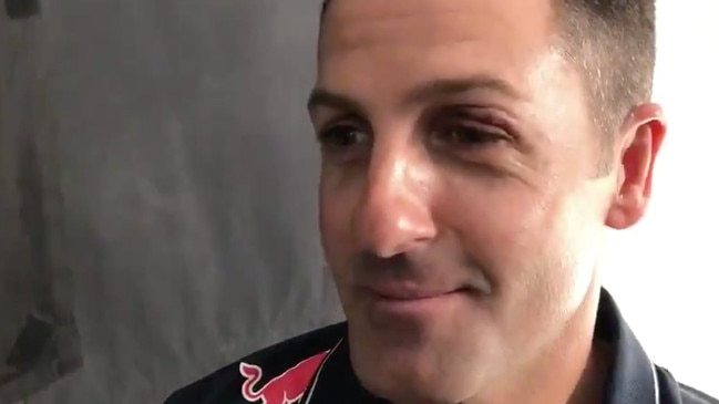 Red Bull Holden Supercars star Jamie Whincup shows off his eye injury.