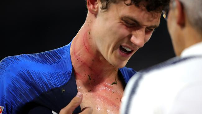 Benjamin Pavard receives medical treatment after being studded in the neck.