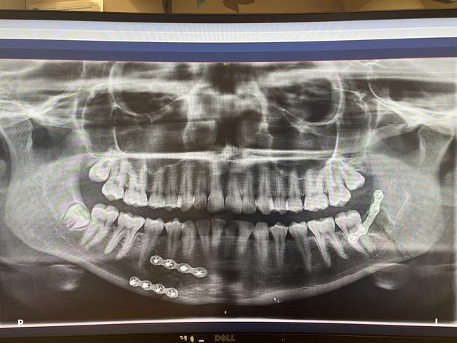 Poppy had to have titanium plates inserted and a wisdom tooth removed in her surgery. Picture: Supplied