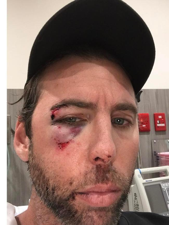 Facial wounds after brother Craig punched him. Picture: Instagram/Grant Hackett