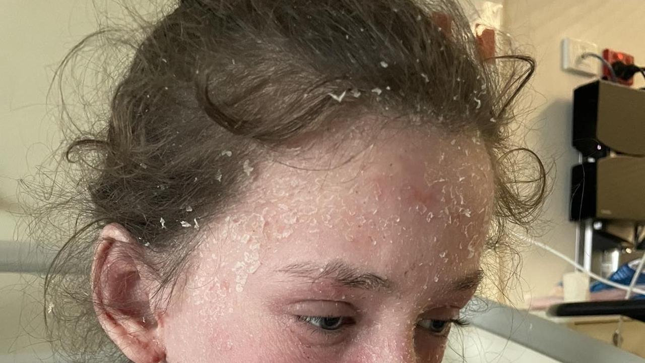 An 11-year-old has developed an allergy to her own tears. Picture: Supplied