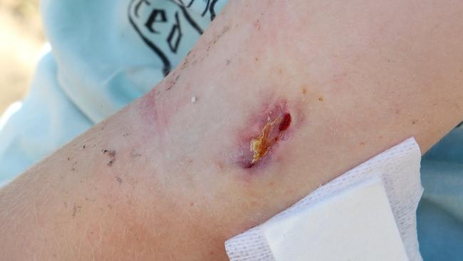 Bairnsdale ulcers can strike young and old. Picture: Alison Wynd