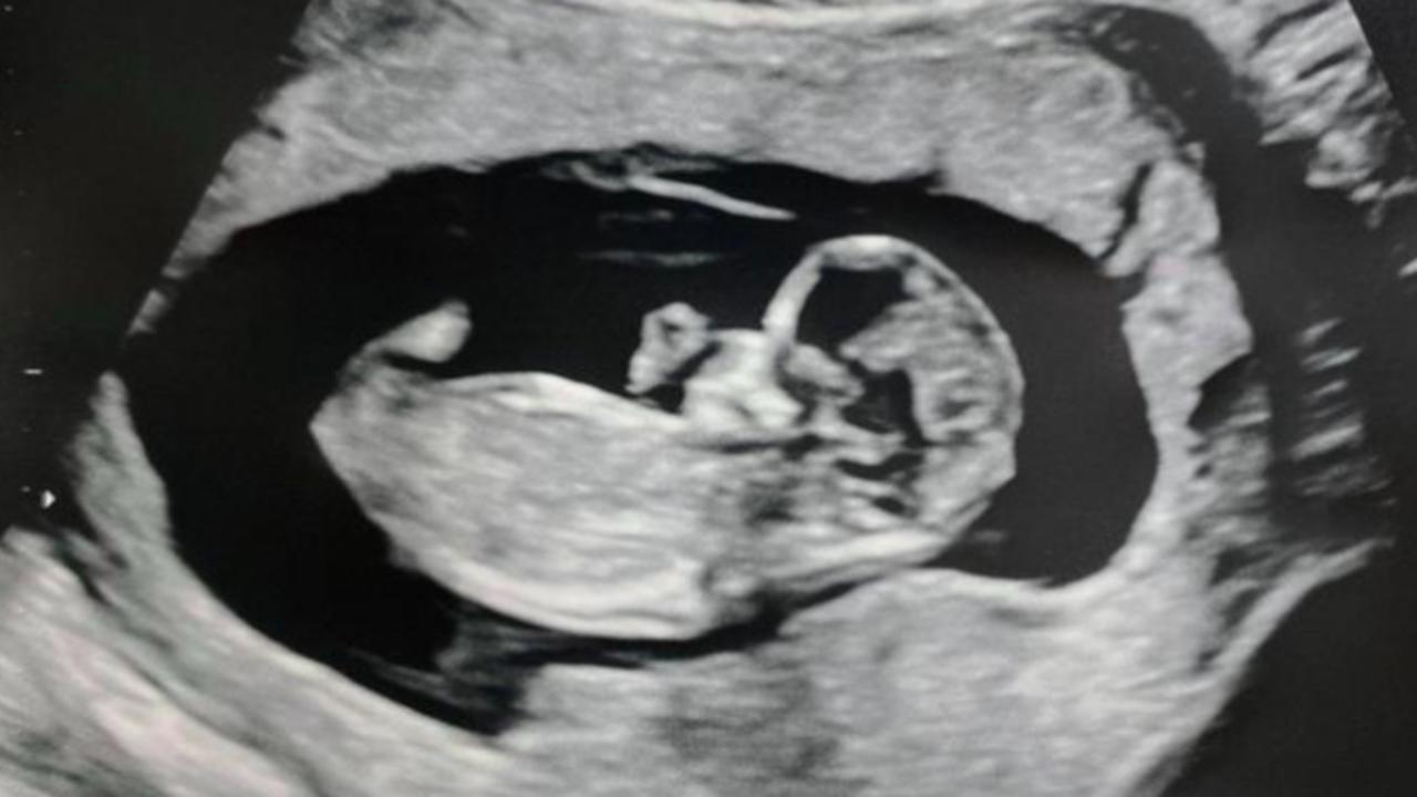 It was at her 19-week scan that the doctors saw ‘something … that would end up changing our lives forever’. Picture: Supplied