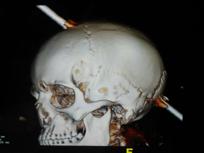 Doctors saved Mohammad Guddu by cutting open the skull bone and pulling out the rod in a five-hour long surgery. Picture: Caters News