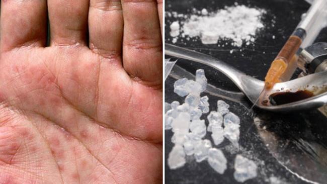 Meth-fuelled orgies are partially to blame for a â&#128;&#156;hideously scaryâ&#128;&#157; syphilis spike in northern NSW, according to a public health expert.