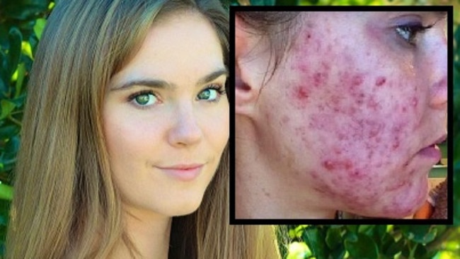 Nina Nelson and her twin sister had severe acne