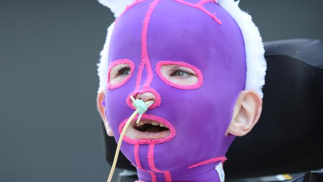 2024 Good Friday Appeal at the Royal ChildrenÃ¢â¬â¢s Hospital. Burns victim Mavis Perry 7 getting into the Easter spirit with bunny ears.                      Picture: David Caird