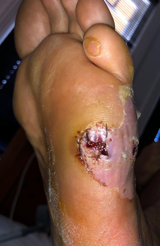 The nasty cut that saw Blake Ferguson admit himself to hospital on Christmas Day and then remain there for 10 days.