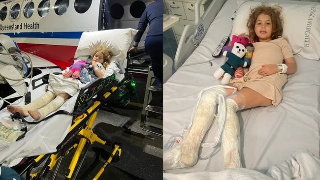 Little Marlow Thurston has a long road to recovery after she sustained significant burns to her legs after a backyard bonfire exploded at her Byfield home.