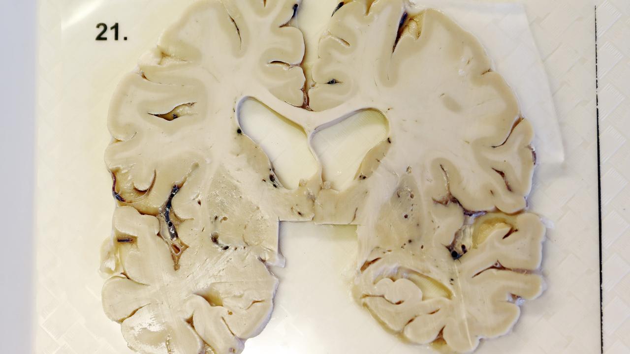 Footballers with CTE experience disabling sense of dysfunction | The