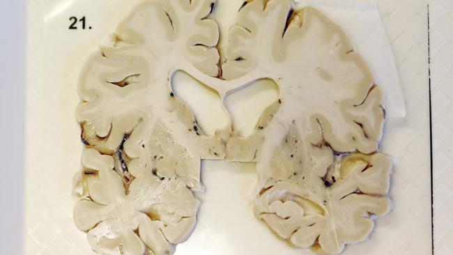 A cross section of a brain donated to the Australian Sports Brain Bank. Picture: Sam Ruttyn