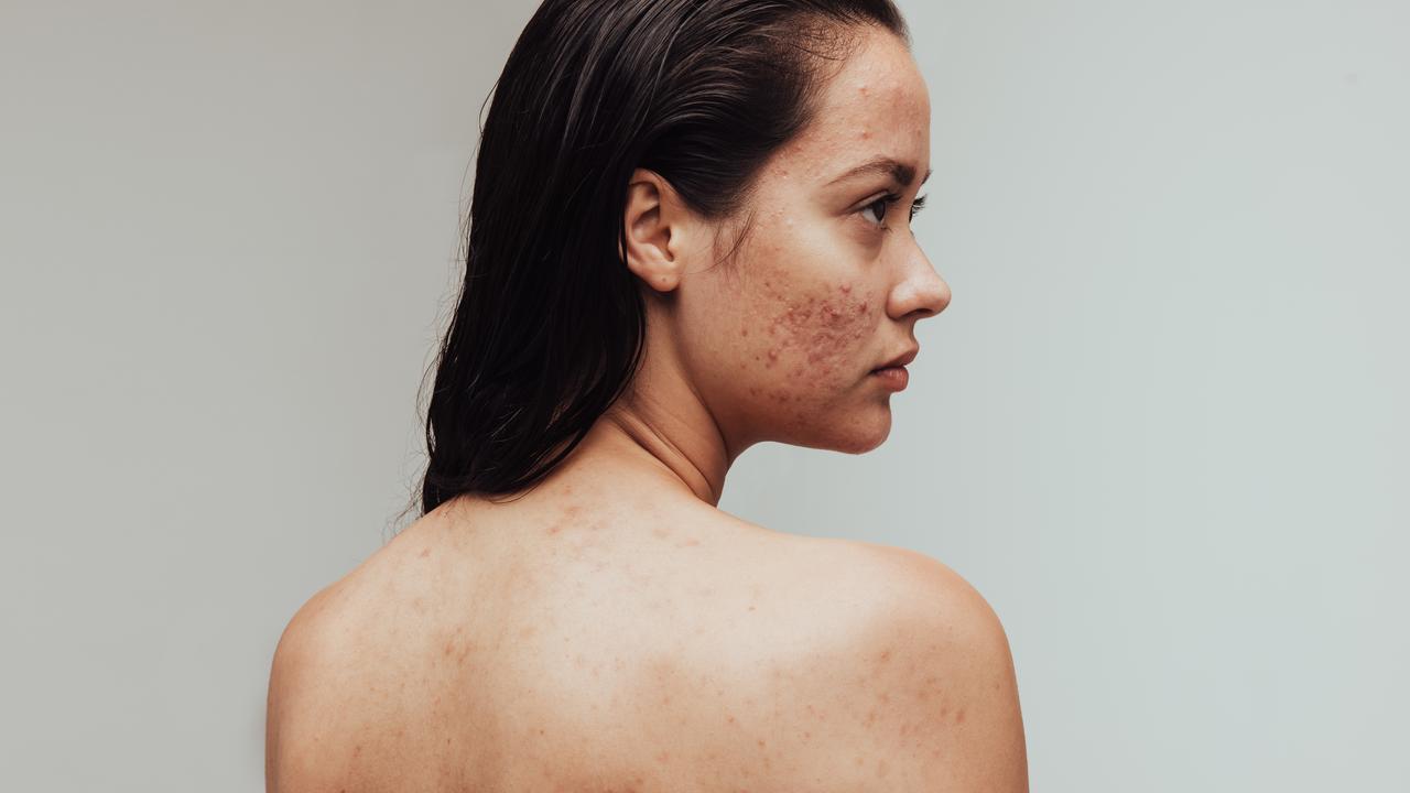 When it comes to treating acne at home, there’s plenty of ingredients you should look for on labels — as well as others you should steer clear of to avoid aggravating your skin. Picture: iStock.