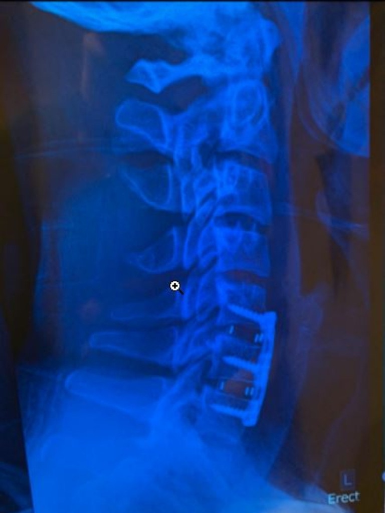 An x-ray of Bines’ neck. Picture: Supplied