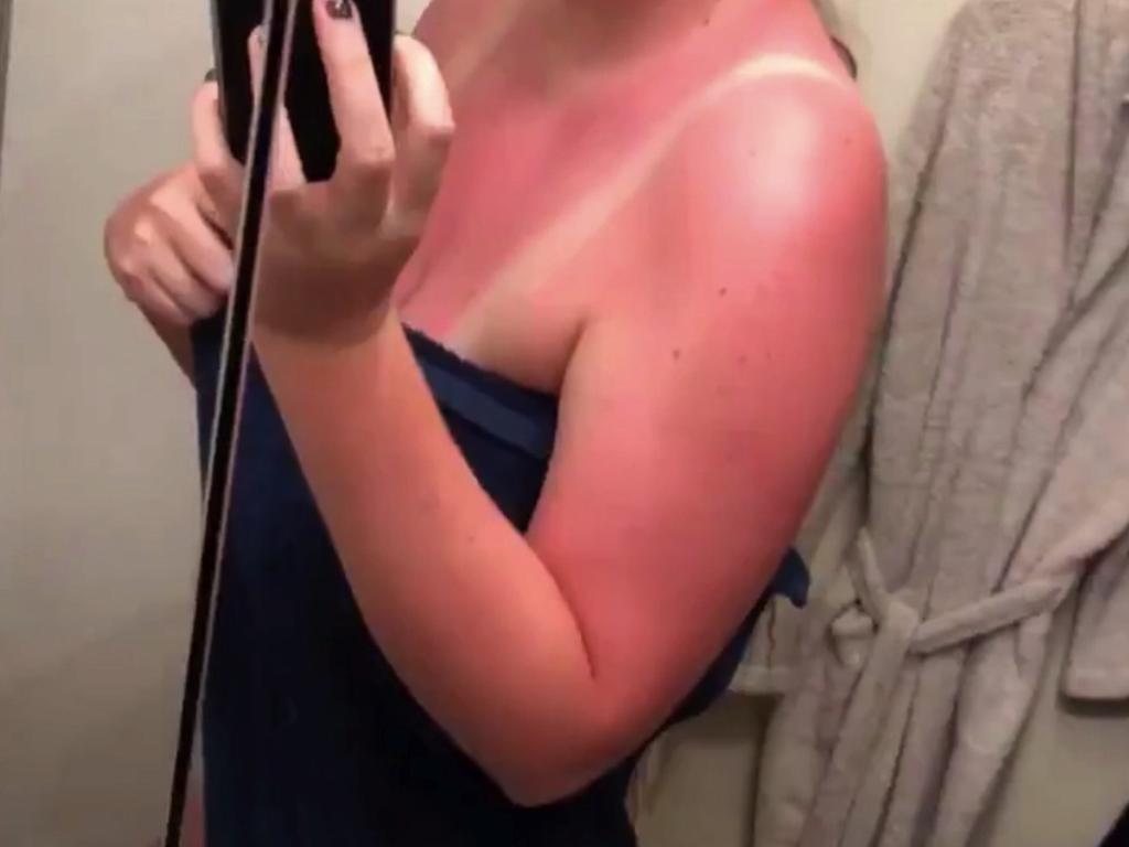 Brits have been sharing their horrendous sunburn fails on social media. Picture: Twitter