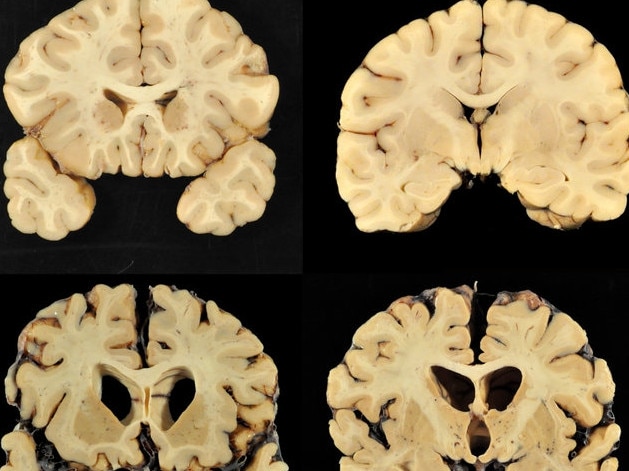 This combination of photos provided by Boston University shows sections from a normal brain, top, and from the brain of former University of Texas football player Greg Ploetz, bottom, in stage IV of chronic traumatic encephalopathy. Picture: LiveScience