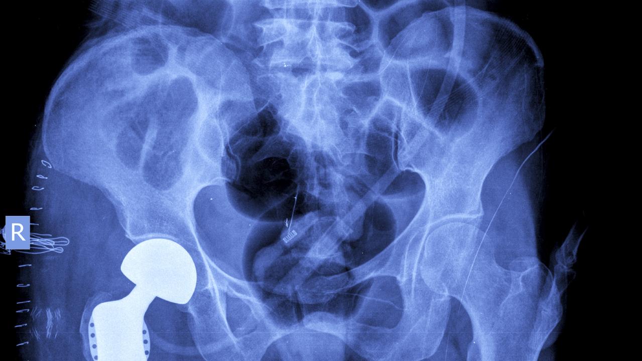 Hip replacements cost more in Australia. Picture istock