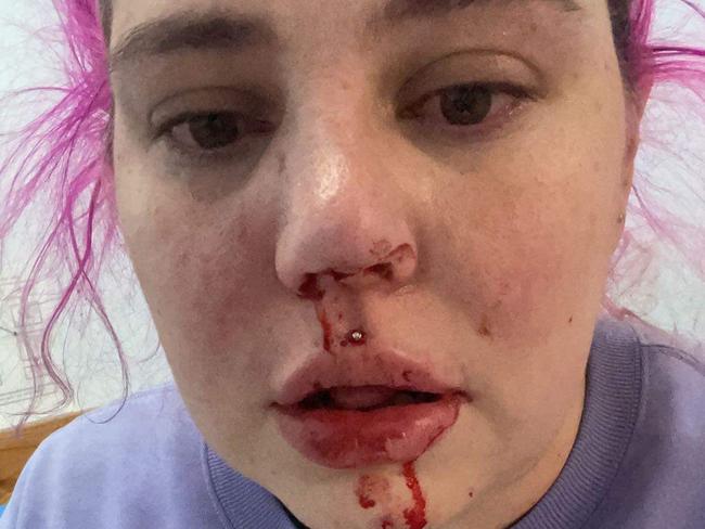 Lara Gilchrist was randomly attacked by a man in Cranbourne. Picture: Supplied