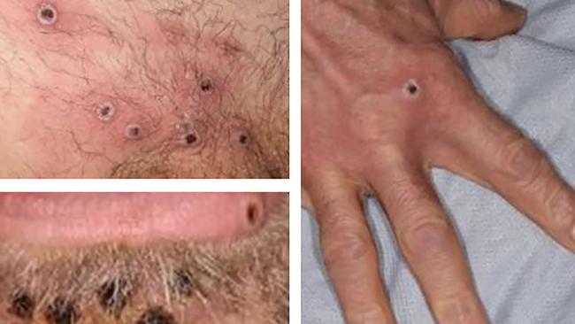 Explained: Aussie monkeypox cases climb