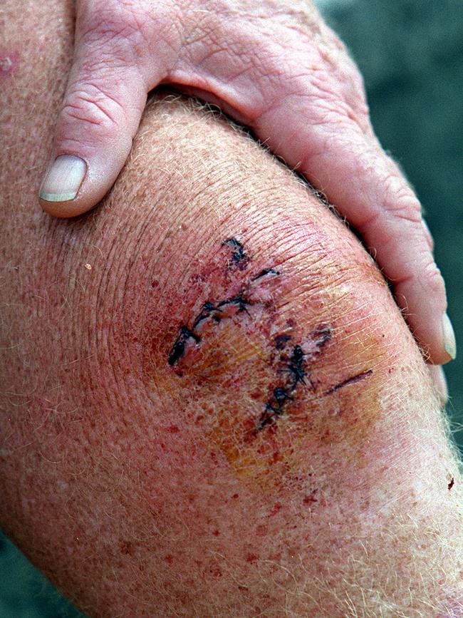 Close-up of Mr Dasey’s wound. Picture: Brett Costello