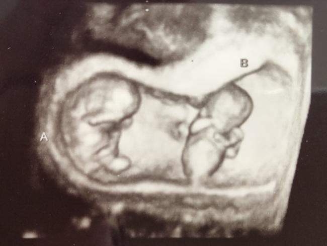 The scan showing the twins sharing the same placenta.
