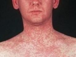 A typical measles rash. Picture: Victoria Department of Health