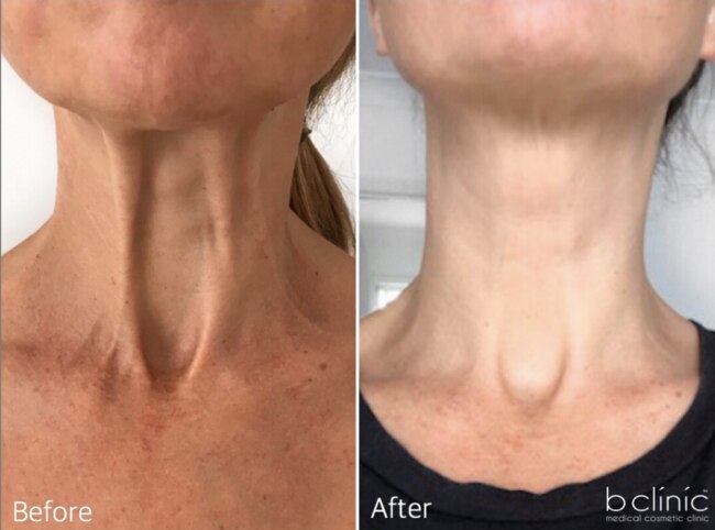 A smoother, younger-looking neck is just one of the aesthetic achievements which can be reached at B Clinic.