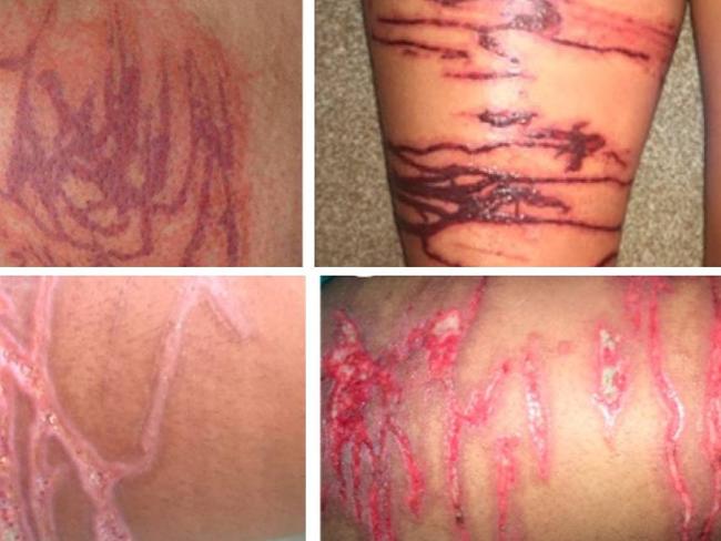 Examples of different Jellyfish stings. Photo: Dermatological Progression of a Probable Box Jellyfish Sting by Auerbach P.S., Gupta D., Van Hoesen K., Zavala A and Review of fatal and severe cases of box jellyfish envenomation in Thailand by Thaikruea L., Siriariyaporn P., Wutthanarungsan R., Smithsuwan P.