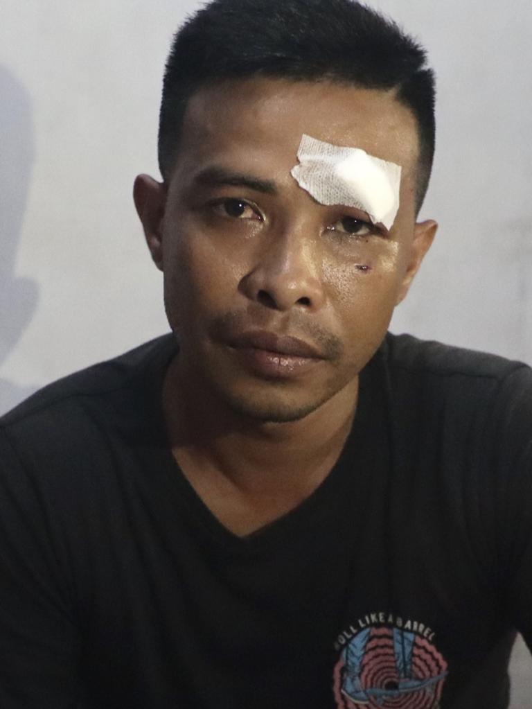 Mr Liu received stitches for his injury. Picture: Lukman S. Bintoro.