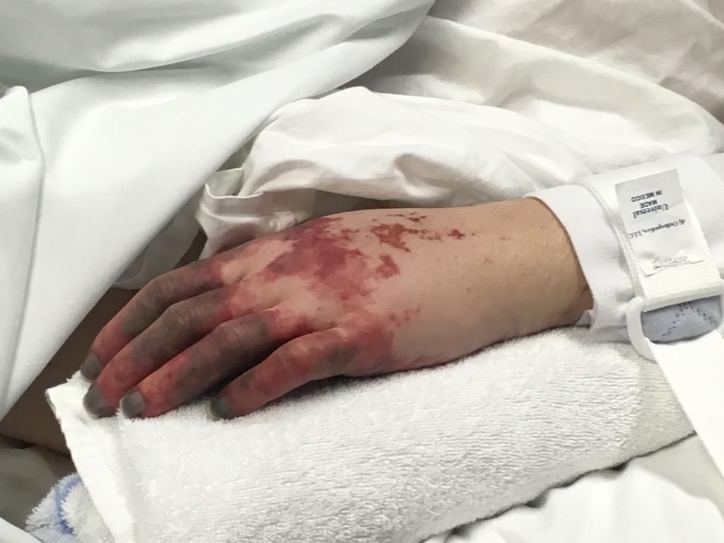 A purple blotchy rash is a sign of the deadly disease. Picture: Sarah Joyce/Supplied