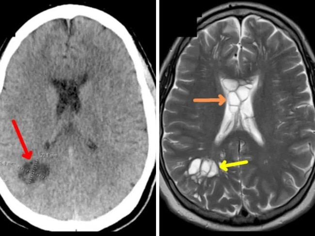 Live worm found in man’s brain after eating uncooked bacon. Picture: American Journal of Case Reports