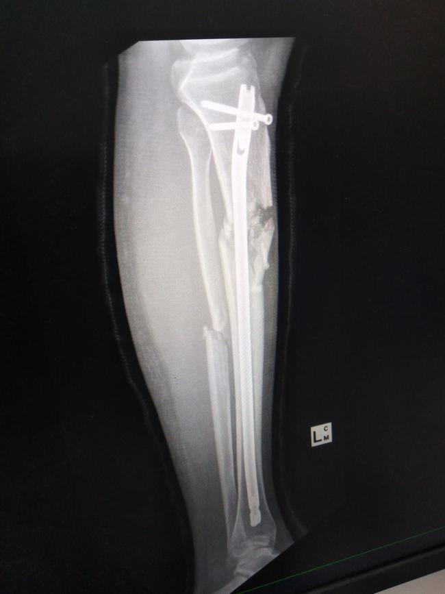 An X-ray image of Jacob Ross's leg after the bolt was put in. Picture: Supplied