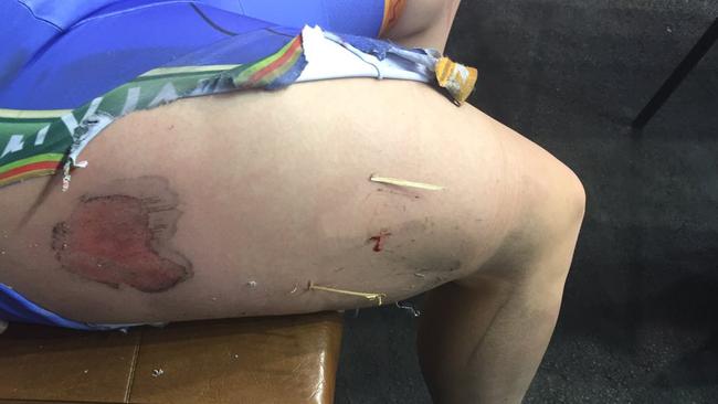 Courtney Field had pieces of the track embedded in her leg after a clash with Olympian Anna Meares last month. Picture: Supplied