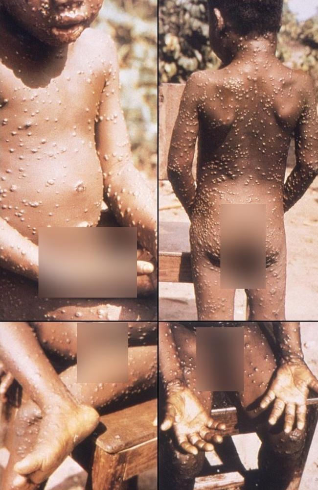 Pictured here, the face, back, feet and hands of a young boy, who had sustained the ravages of the characteristic maculopapular Mpox cutaneous rash in 1997. Picture: CDC Public Health Image Library