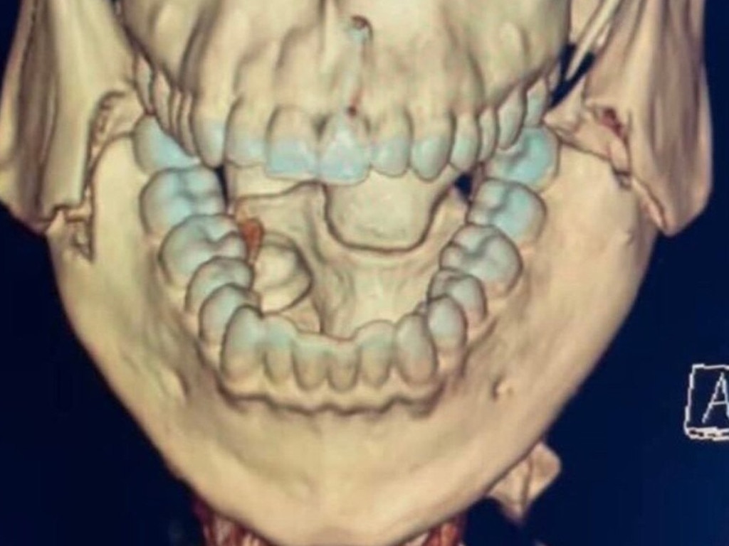 The X-ray of Opetaia's busted jaw after his world title win. Picture: Supplied