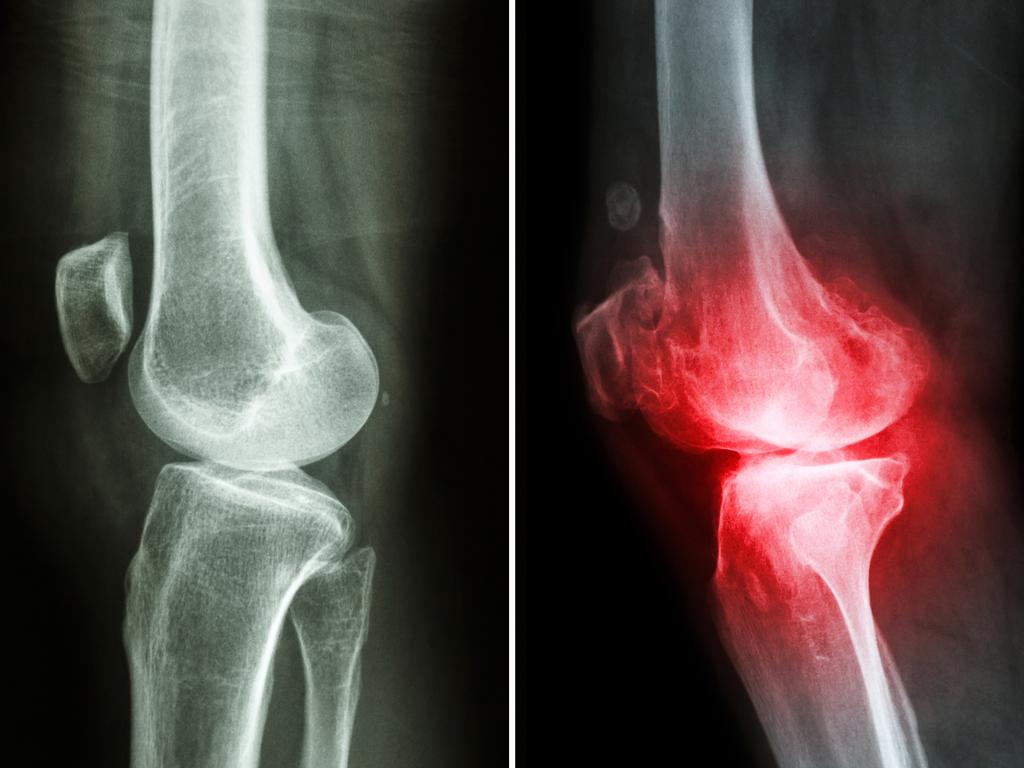 A normal knee (left image) and osteoarthritis knee (right image).