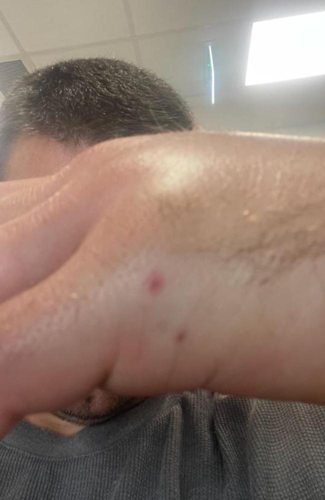 The unnamed dad shows off his swollen hand after being bitten by a potentially deadly snake. Picture: Facebook